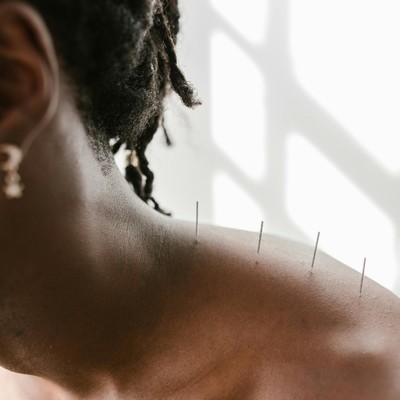 Acupuncture for pain relief and chronic conditions.