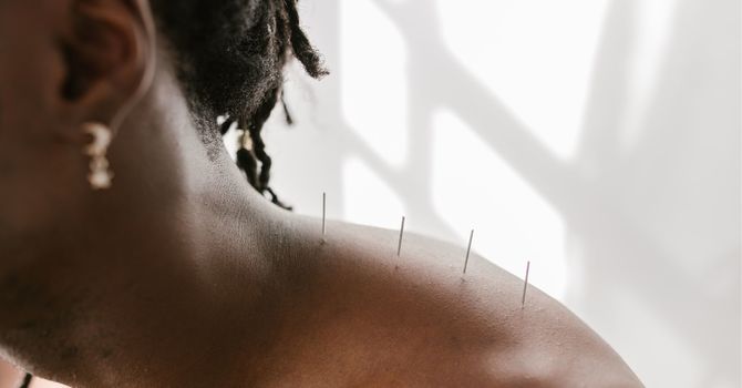 Fertility Acupuncture